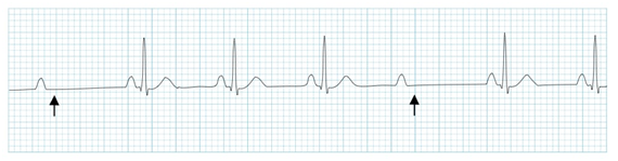 常见心律失常的急诊处理（心血管医生值班必备）