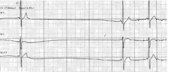 常见心律失常的急诊处理（心血管医生值班必备）