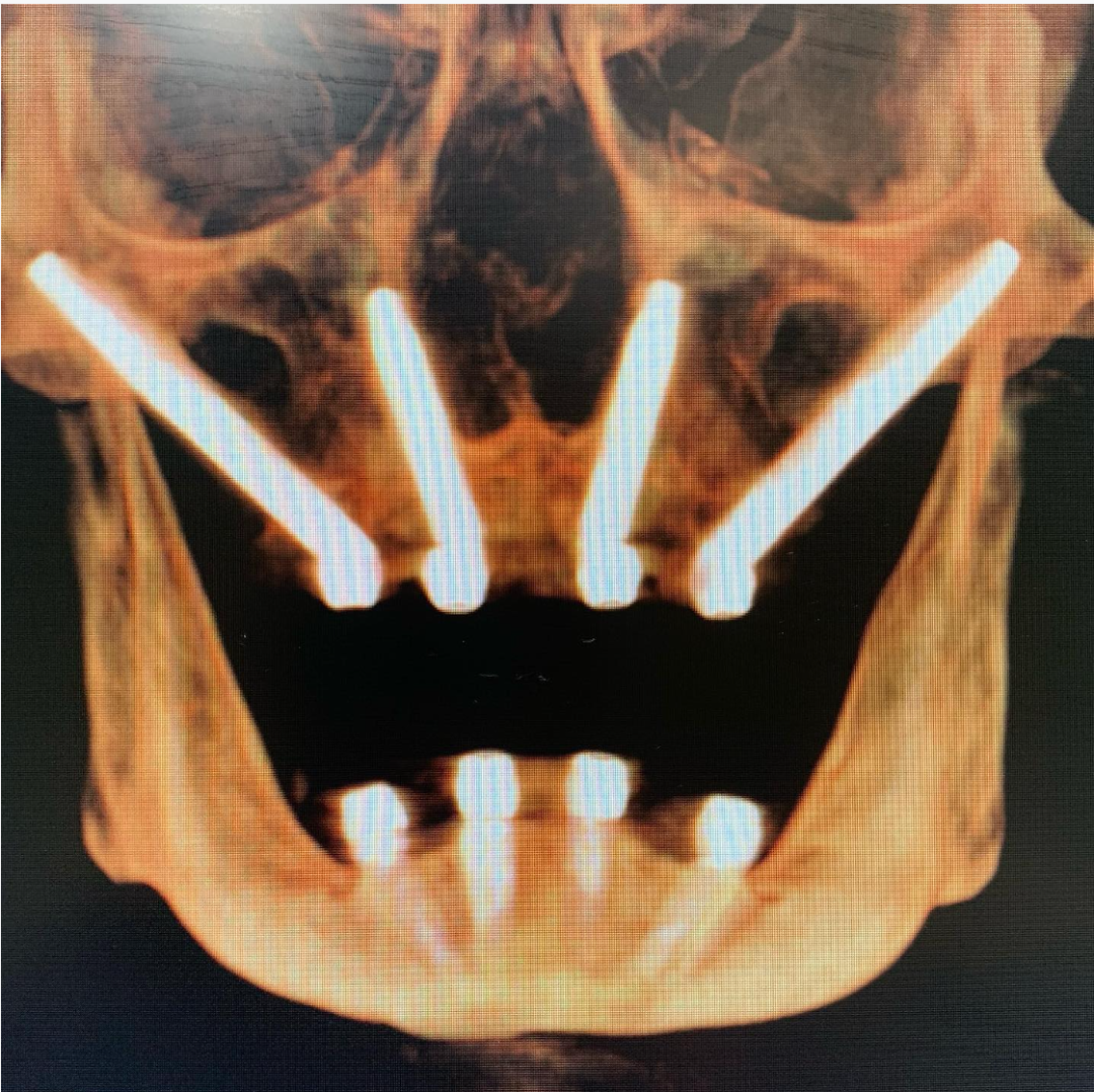这样的种植方式，比穿颧穿翼更少见