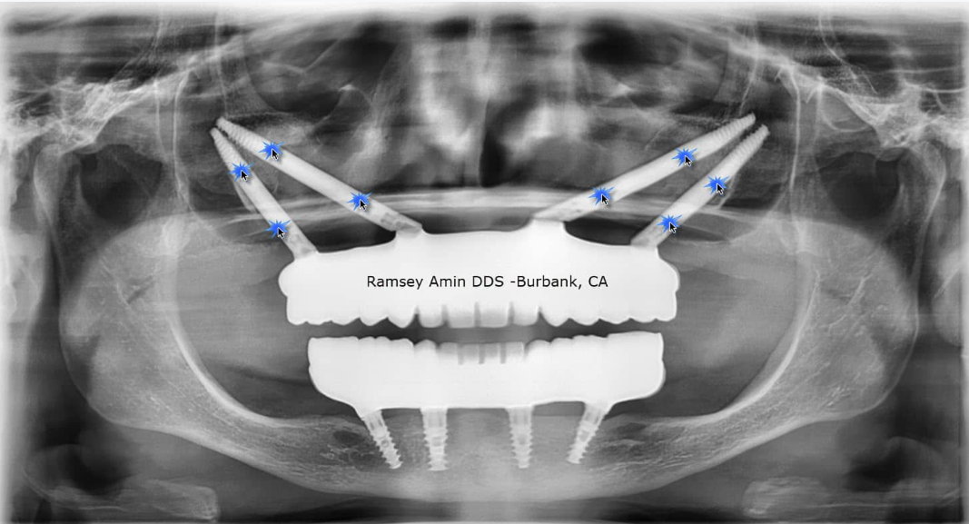 这样的种植方式，比穿颧穿翼更少见