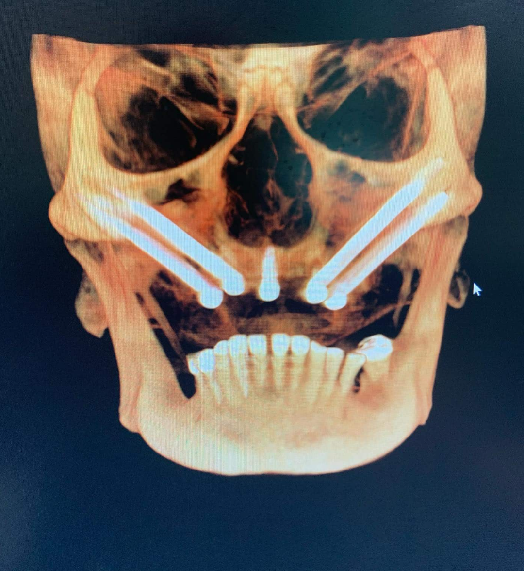 这样的种植方式，比穿颧穿翼更少见