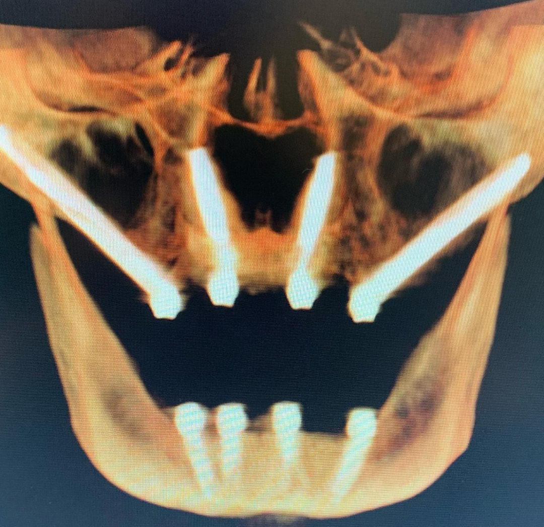 这样的种植方式，比穿颧穿翼更少见