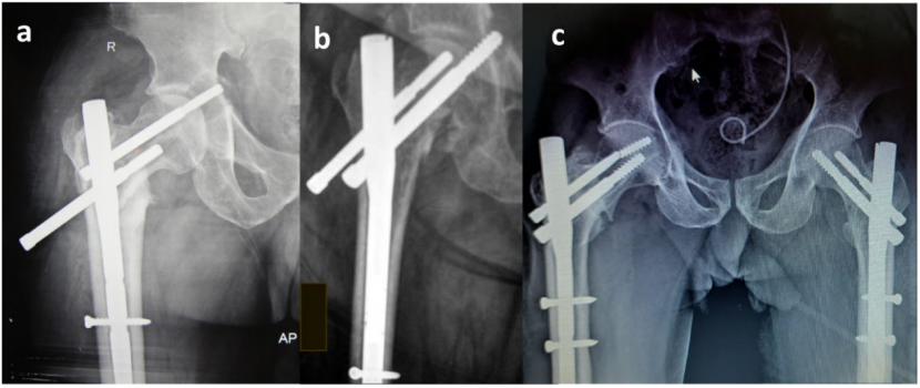 髓内钉治疗股骨粗隆间骨折，这10个关键点你需要知道！