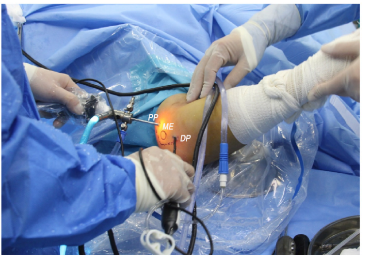 全关节镜下尺神经松解并皮下前置术