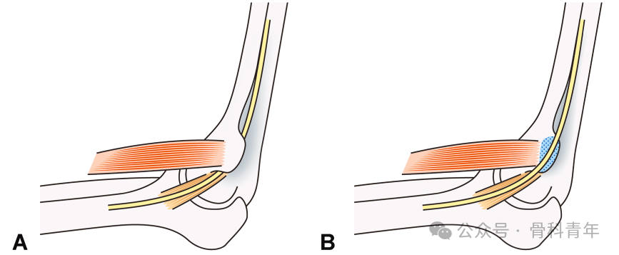 肘管综合征诊疗方案专家共识（2025版）
