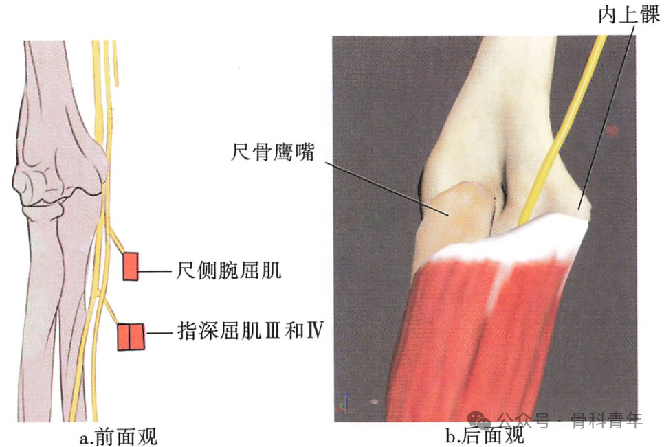 肘管综合征诊疗方案专家共识（2025版）