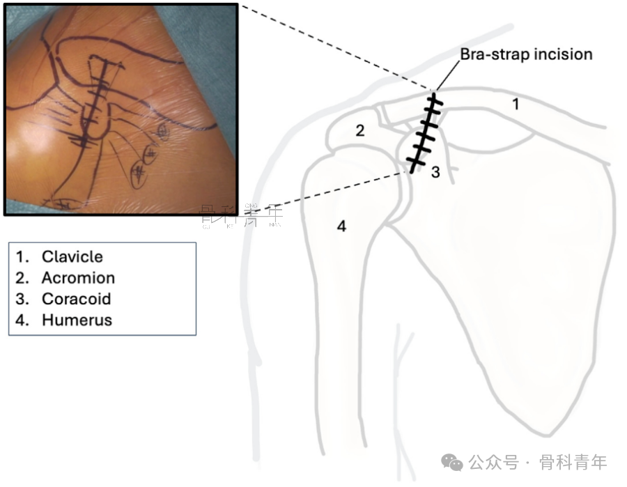 “8步骤”图解肩锁关节脱位改良入路Tightrope内固定