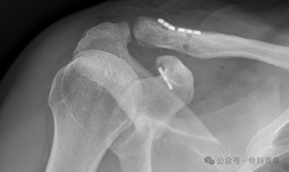 “8步骤”图解肩锁关节脱位改良入路Tightrope内固定
