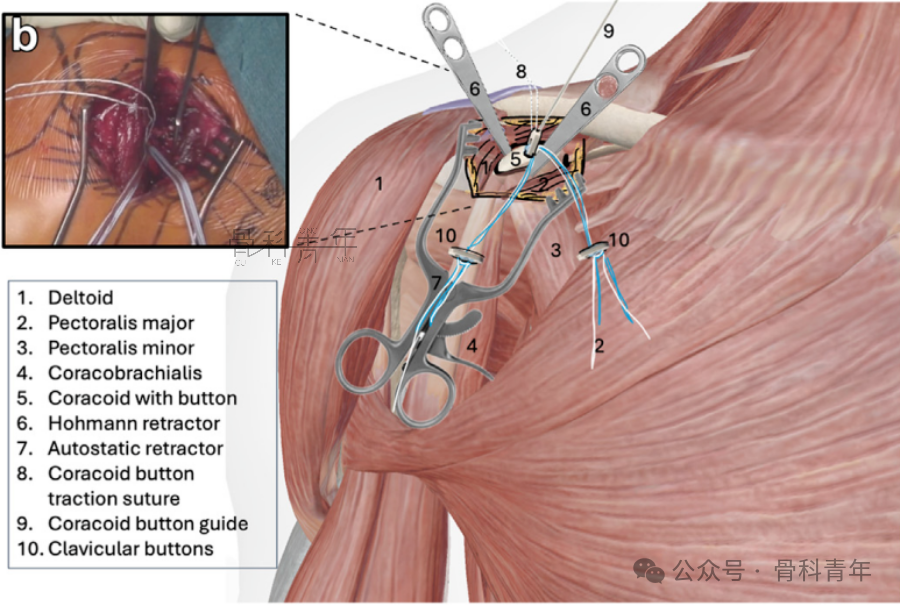 “8步骤”图解肩锁关节脱位改良入路Tightrope内固定