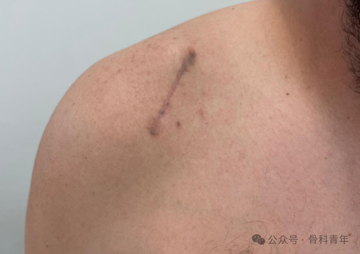 “8步骤”图解肩锁关节脱位改良入路Tightrope内固定