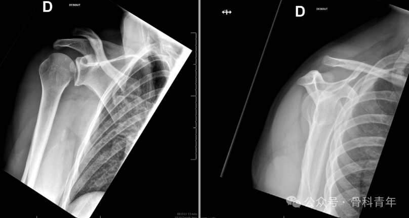 “8步骤”图解肩锁关节脱位改良入路Tightrope内固定