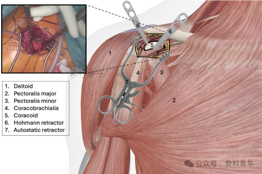 “8步骤”图解肩锁关节脱位改良入路Tightrope内固定