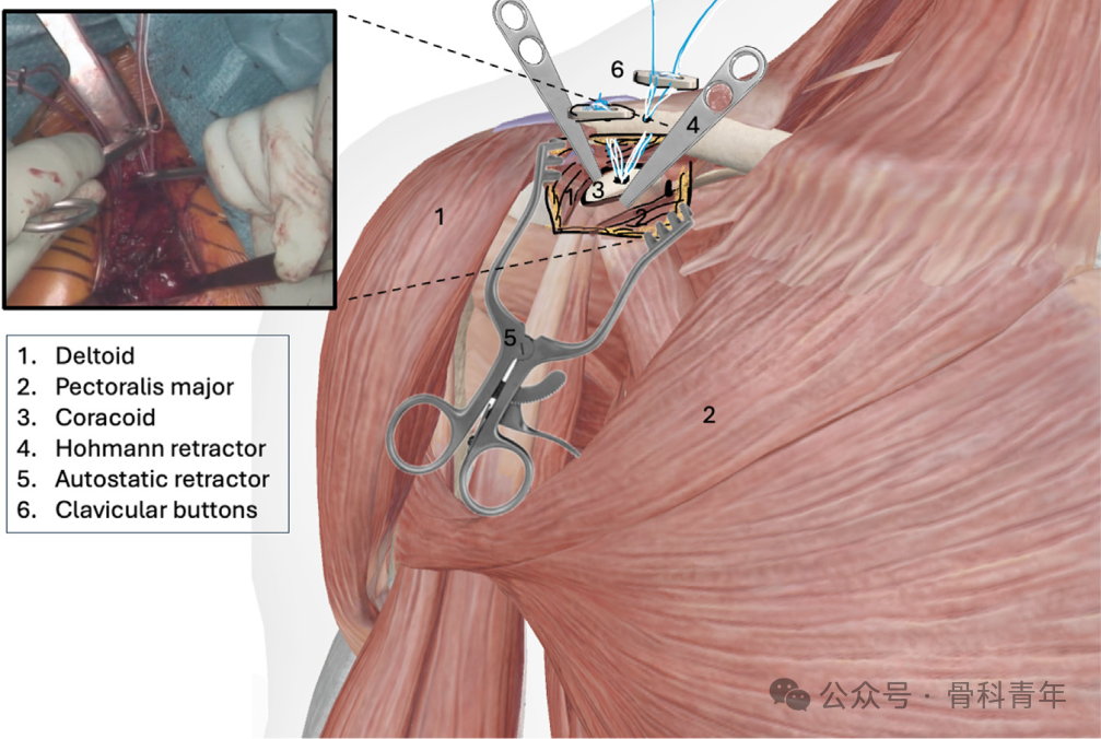 “8步骤”图解肩锁关节脱位改良入路Tightrope内固定