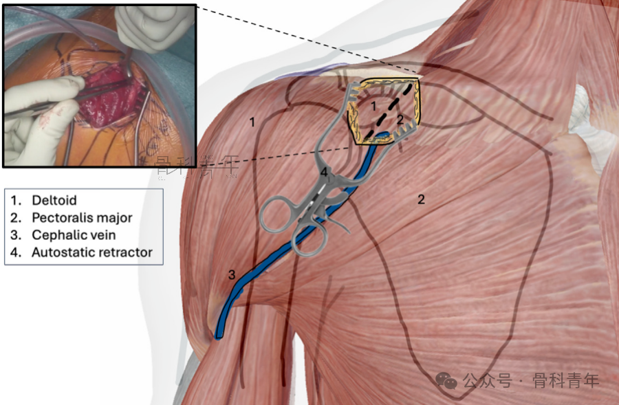 “8步骤”图解肩锁关节脱位改良入路Tightrope内固定