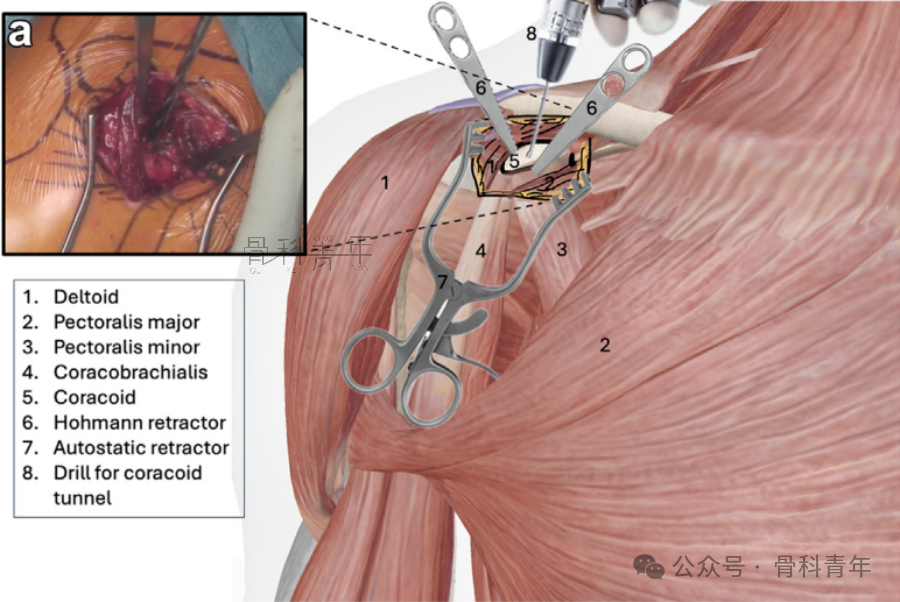 “8步骤”图解肩锁关节脱位改良入路Tightrope内固定