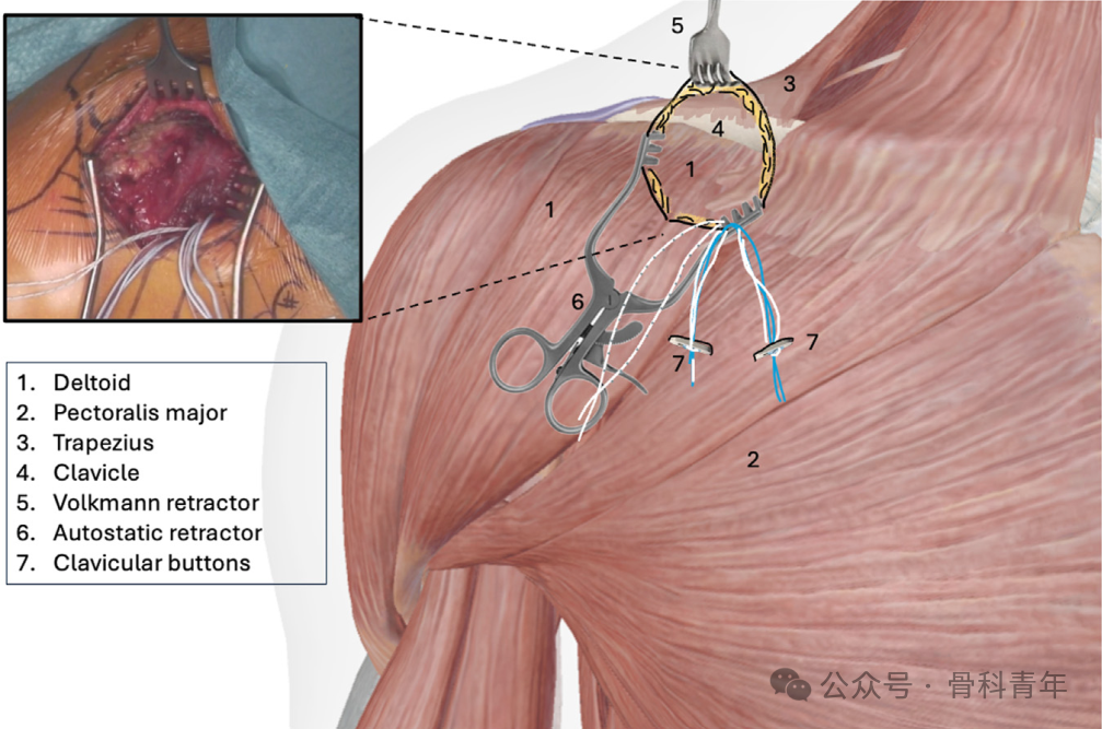 “8步骤”图解肩锁关节脱位改良入路Tightrope内固定