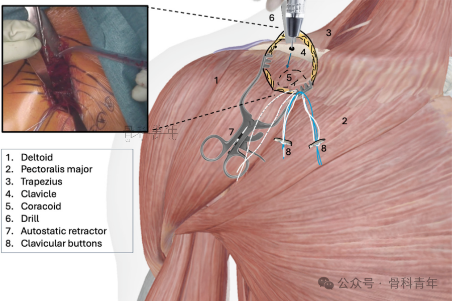 “8步骤”图解肩锁关节脱位改良入路Tightrope内固定