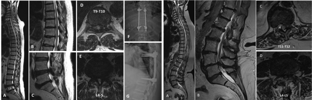【文献精读】串联型椎管狭窄症的分型和治疗策略