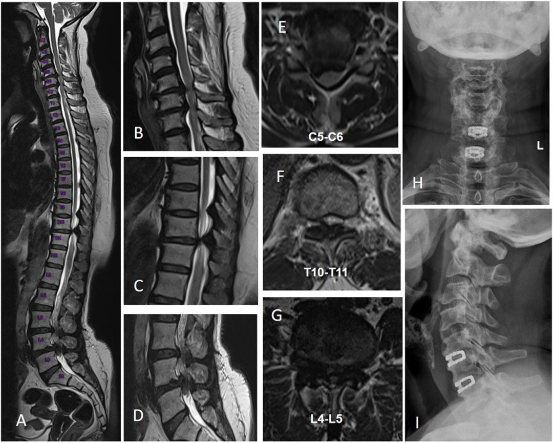 【文献精读】串联型椎管狭窄症的分型和治疗策略