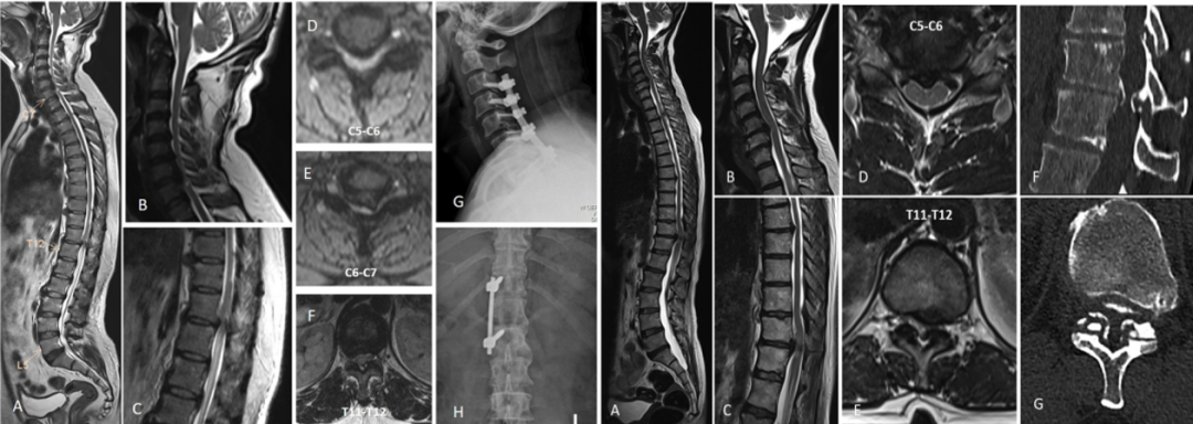 【文献精读】串联型椎管狭窄症的分型和治疗策略