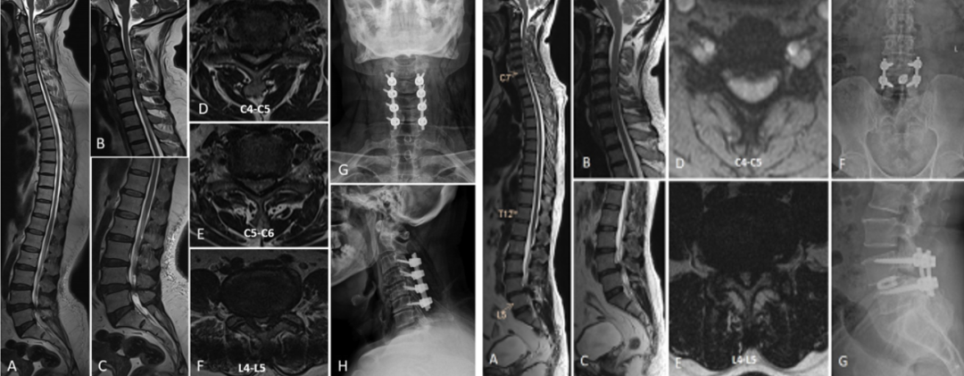 【文献精读】串联型椎管狭窄症的分型和治疗策略